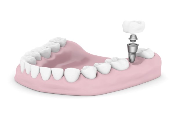 When Would You Need Dental Implants?