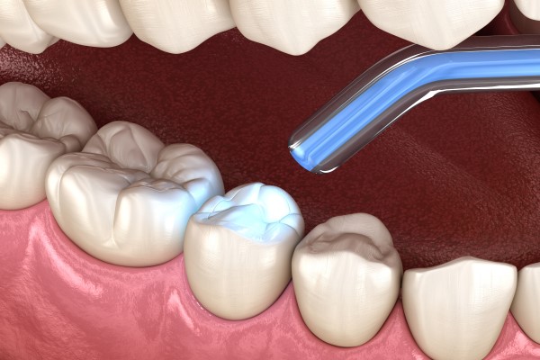 Can A Dental Filling Be Replaced?