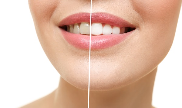Should I Have My Teeth Cleaned Before Professional Teeth Whitening?