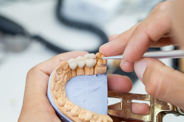 Traditional Vs Implant Supported Dental Bridges
